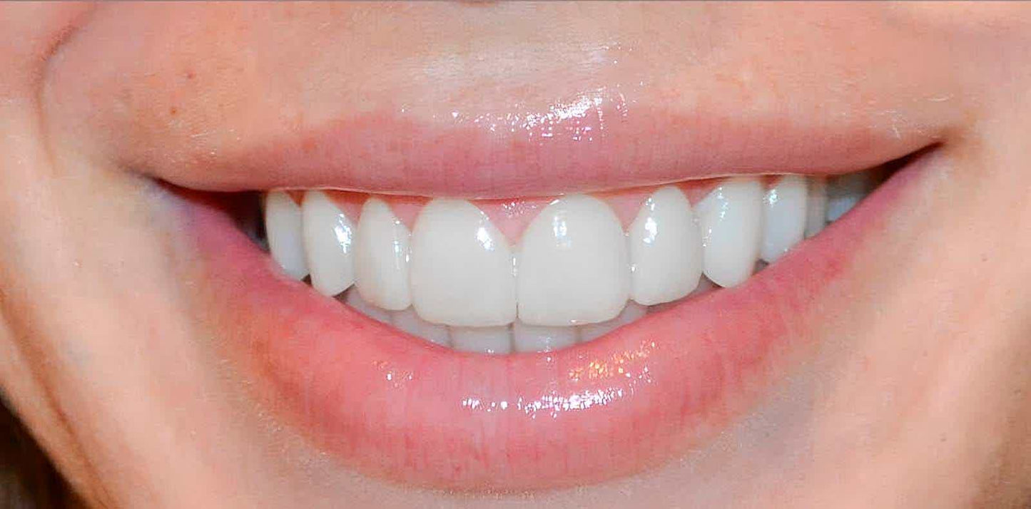 Moldura Sonrisa Smile- 50% DESCUENTO