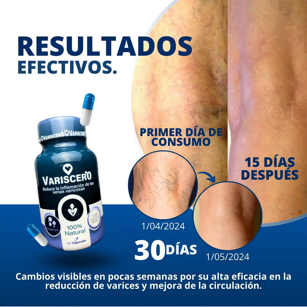 Varices - 50% DESCUENTO