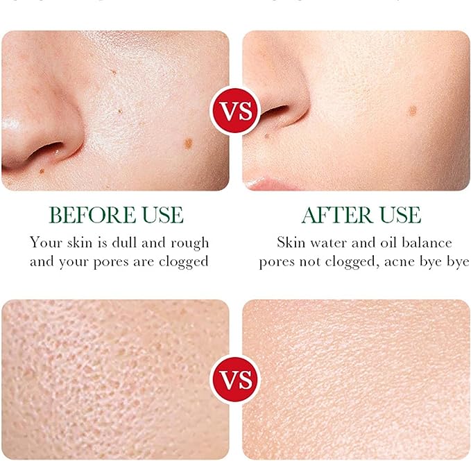 ACNÉ REMOVAL