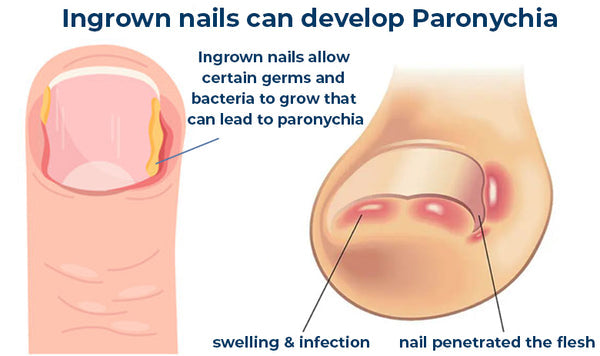 Serum removedor de Uñas encarnadas