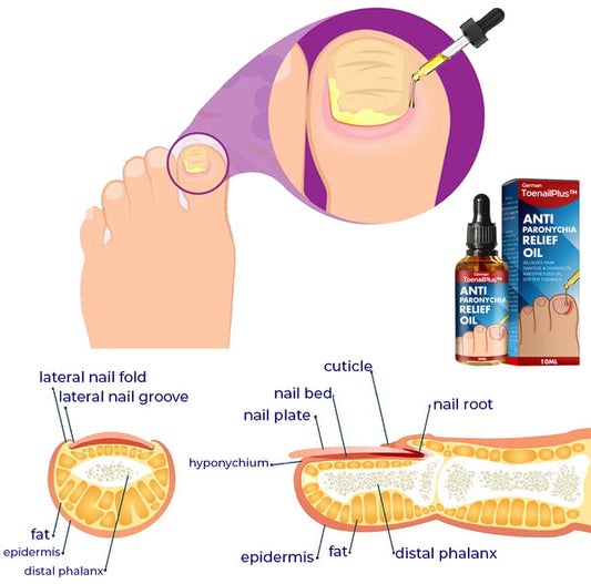 Serum removedor de Uñas encarnadas